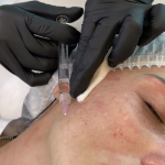 Skinbooster  - Hidratación profunda - Imagen 2