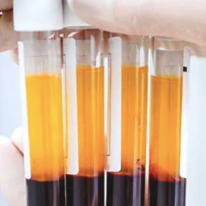 Mesoterapia con Plasma rico en plaquetas