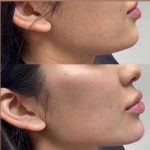 Marcado Mandibular - TEOXANE Ácido Hialurónico - Imagen 2