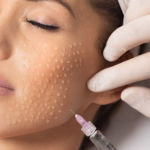 Mesoterapia PINK GLOW (3 sesiones) - Imagen 2