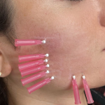 Hilos PDO Revitalizantes en cara