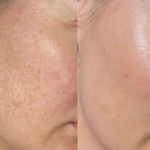 PEEL BCN - Peeling Superficial - Imagen 3