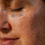 Valle de lagrimas - TEOXANE Ácido Hialurónico