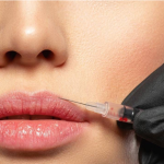 Labios - TEOXANE Ácido Hialurónico