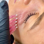 Hilos PDO Revitalizantes en ojeras