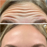 NABOTA Toxina Botulínica 3 zonas - Imagen 4