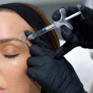 Fosa Temporal  -  TEOXANE Ácido Hialurónico