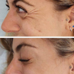 NABOTA Toxina Botulínica 3 zonas - Imagen 3