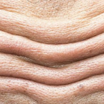 Arrugas Profundas - Teoxane Ácido Hialurónico