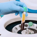 Mesoterapia con Plasma rico en plaquetas capilar 6 sesiones - Imagen 3