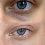 Hiperpigmentación de ojeras