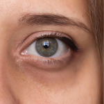 Ojeras - TEOXANE Ácido Hialurónico - Imagen 2