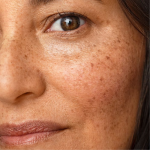 Reposición de tercio medio - TEOXANE Ácido Hialurónico