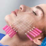 Hilos PDO Revitalizantes en cara - Imagen 2