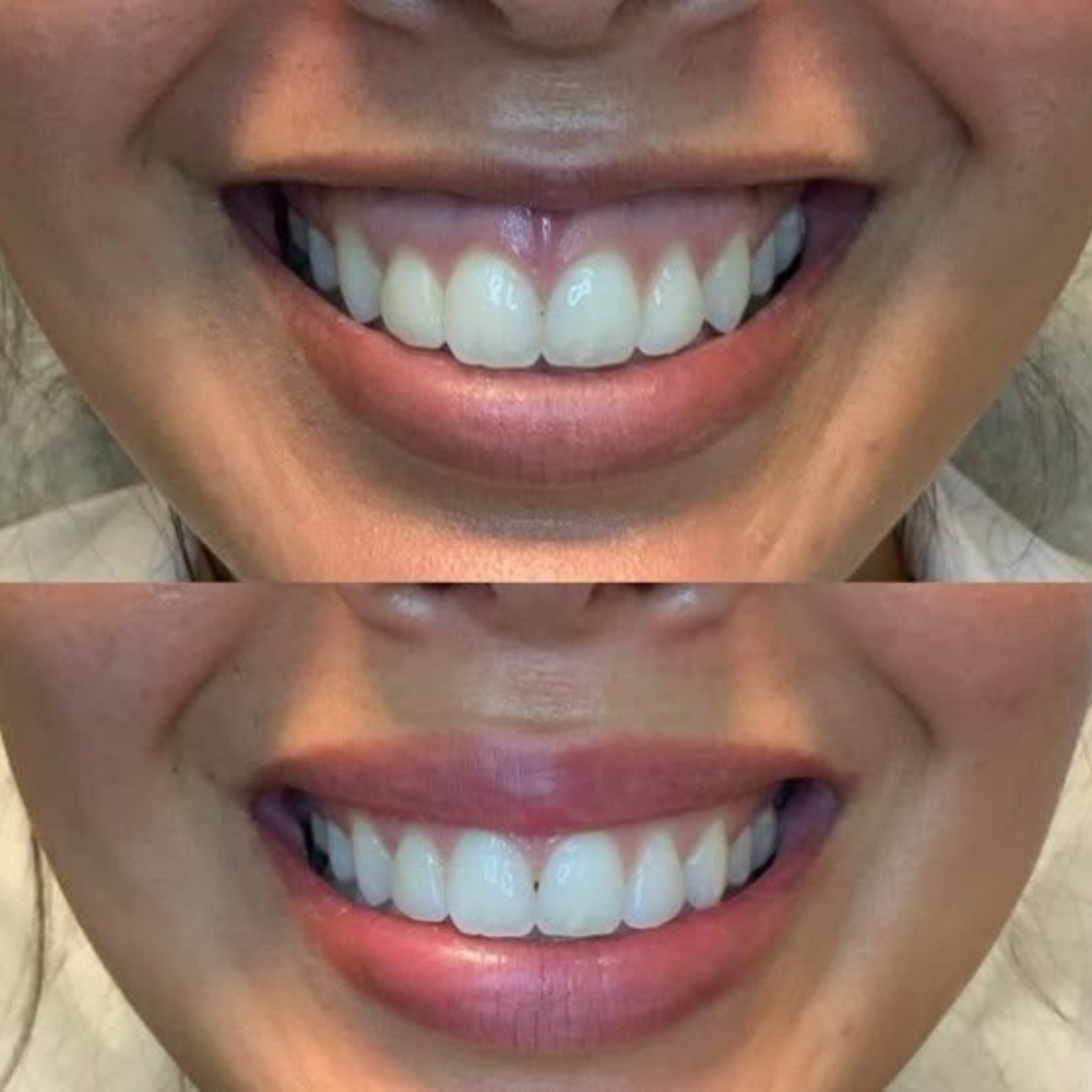 sonrisa gingival Sonrisa gingival - Toxina botulínica - Imagen 1